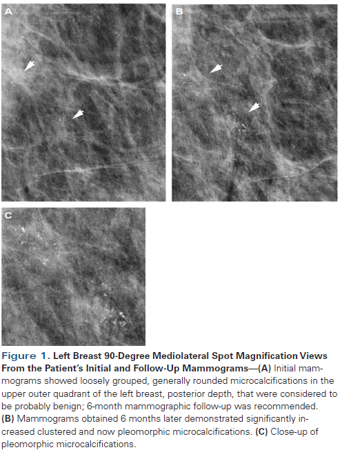 The Case of Misleading DCIS Presentation